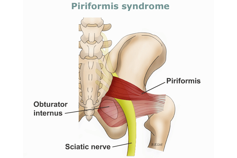 Piriformis Sydrome a piece of the larger puzzle